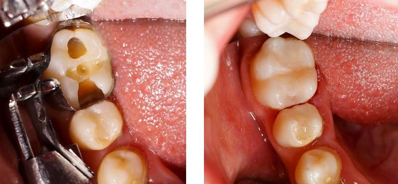 TC dental inlays and onlays