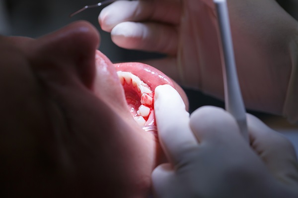 Upper-Mt-Gravatt-Dentist-gums-bleed-gingivities