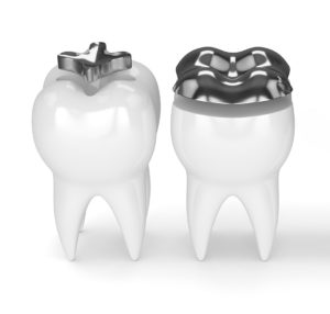 inlay-onlay-TC-dental-group-upper-mt-gravatt-dentist