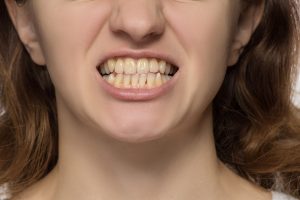 TC-dental-tooth-erosion-causes