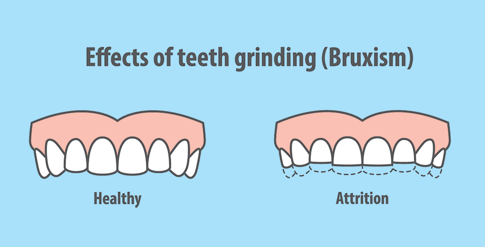 TC-dental-Teeth_grinding_bruxism_effects