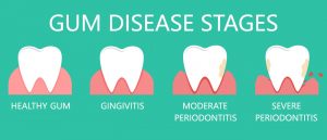 Gum Disease stages