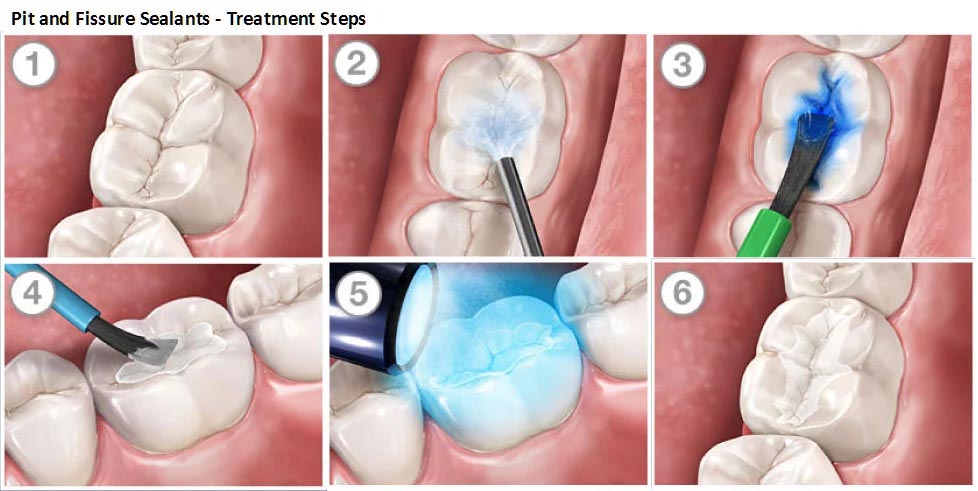 How do fissure sealants prevent child tooth decay and cavities?