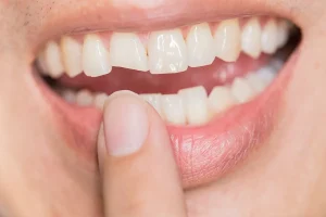 Chip teeth treatment