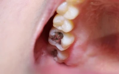 Common tooth damage and repair options