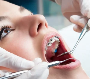 Traditional metal braces