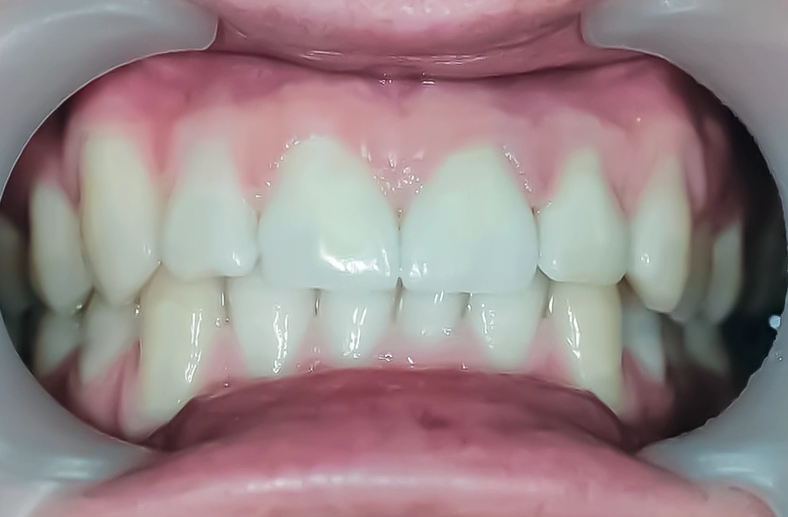 worn smile restored
