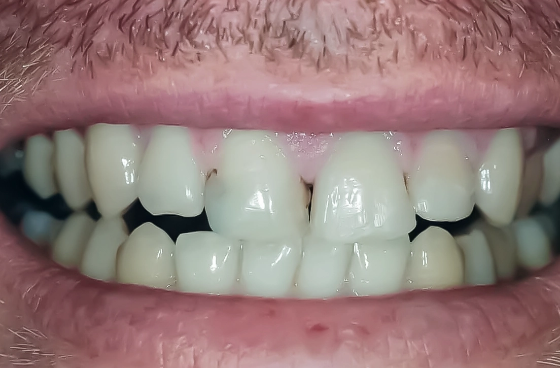 Restoring a worn smile