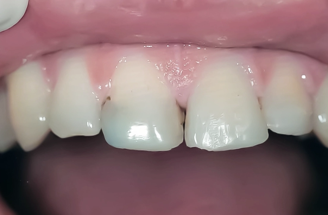 Restoring a worn smile