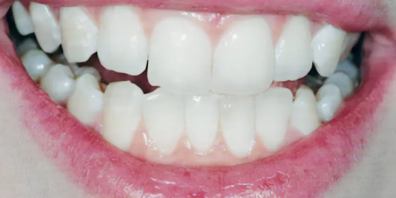 resin infiltration