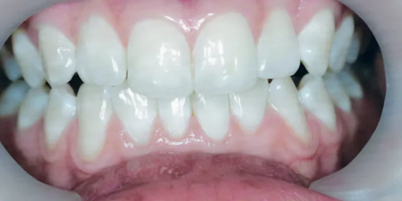 resin infiltration