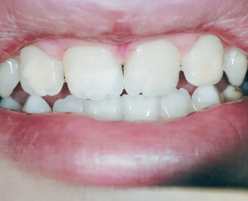  resin infiltration