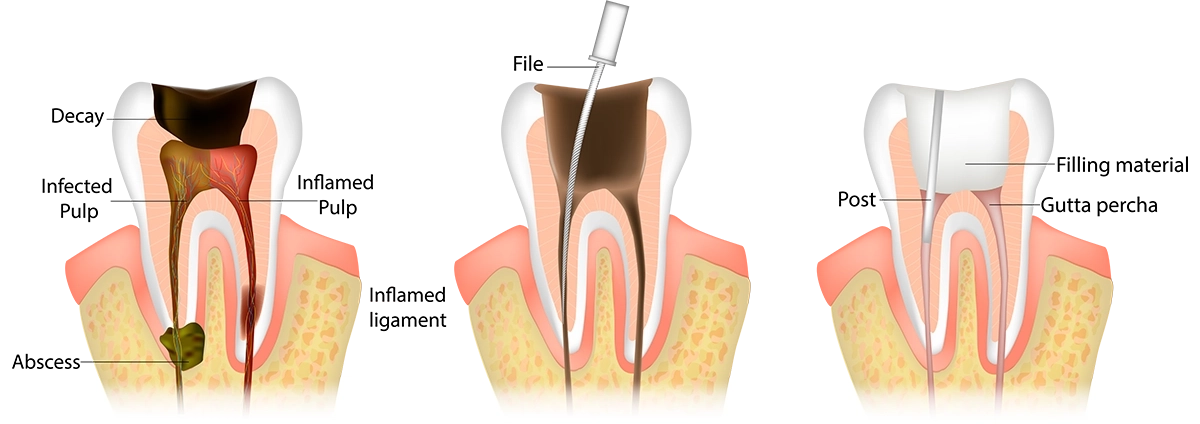 TCDental - Blog - Preserving your natural teeth with root canal therapy - root canal theraphy illustration - v1 Preserving your natural teeth with root canal therapy