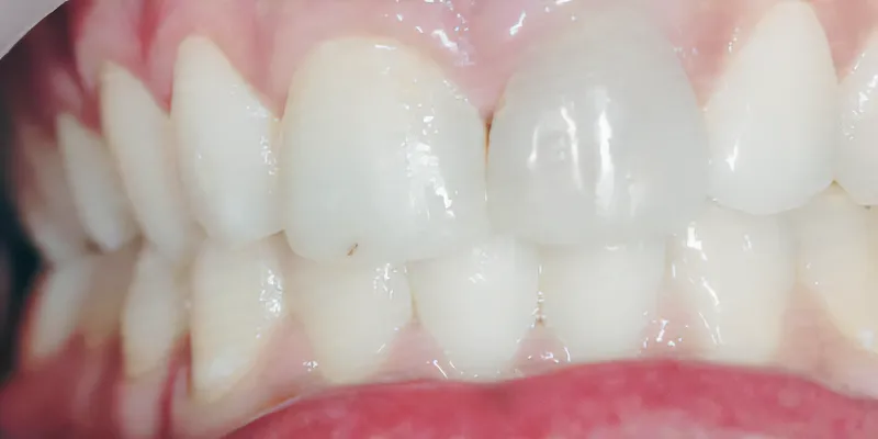 Internal Bleaching & Composite Veneers