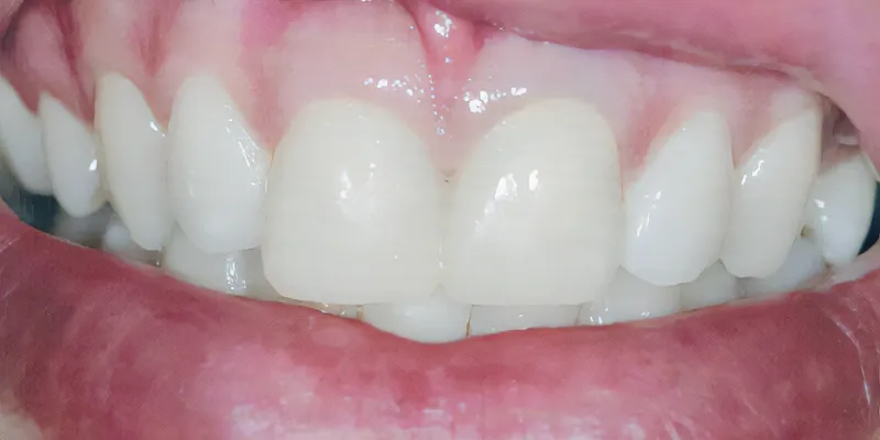 Composite Veneers