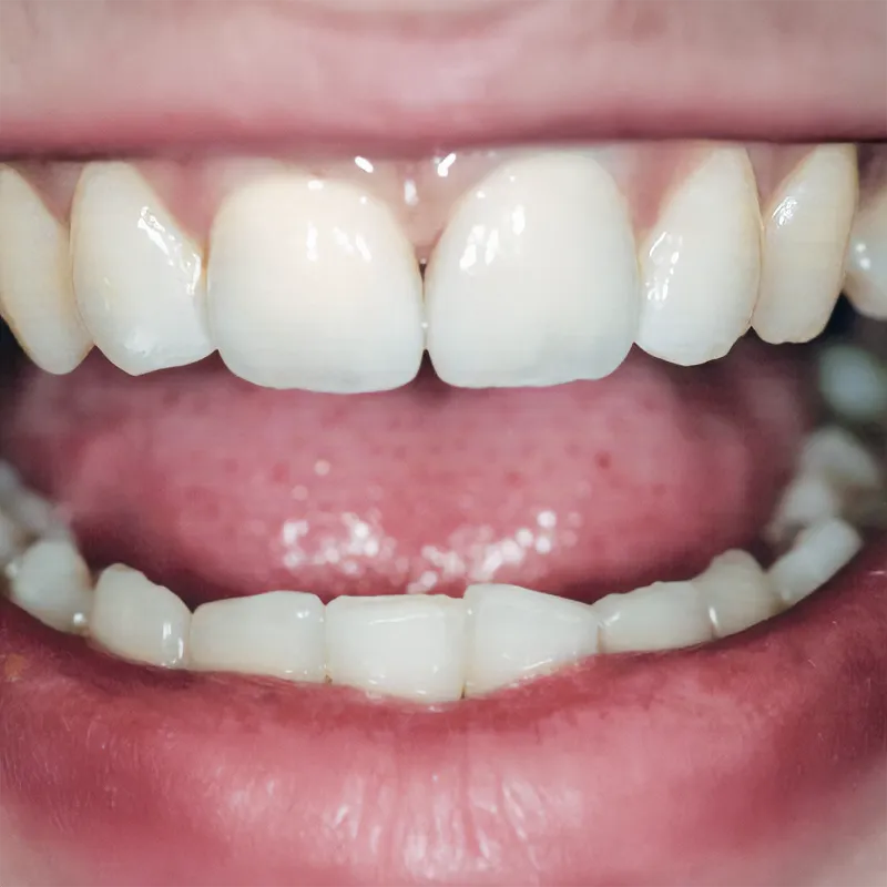 Composite Veneers