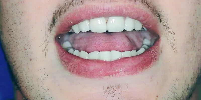 Internal Bleaching & Composite Veneers