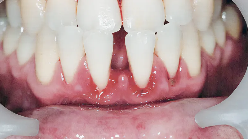 Professional Cleaning & Gum Therapy