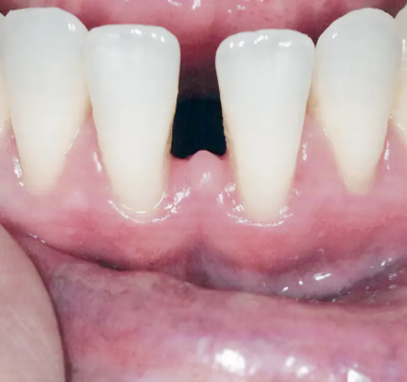 Professional Cleaning & Gum Therapy