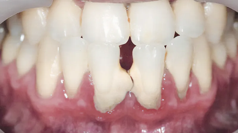 Professional Cleaning & Gum Therapy