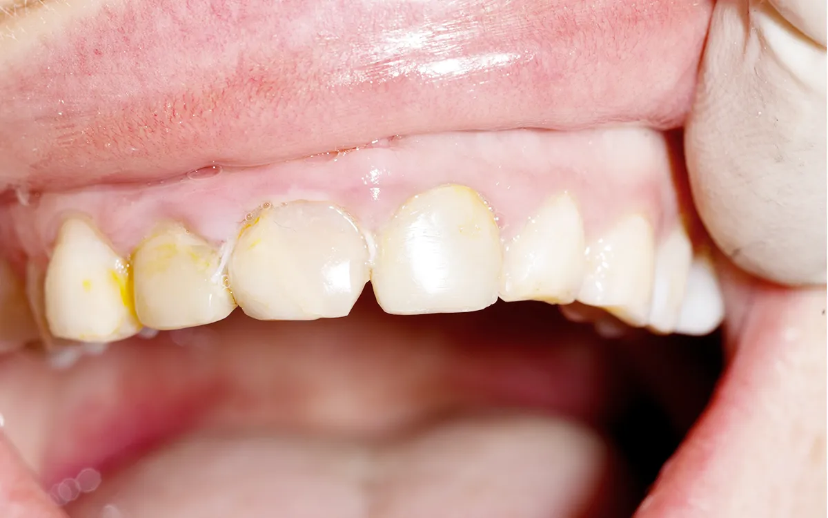 causes enamel to wear down causes enamel to wear down