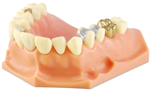 Are your amalgam fillings past their prime?