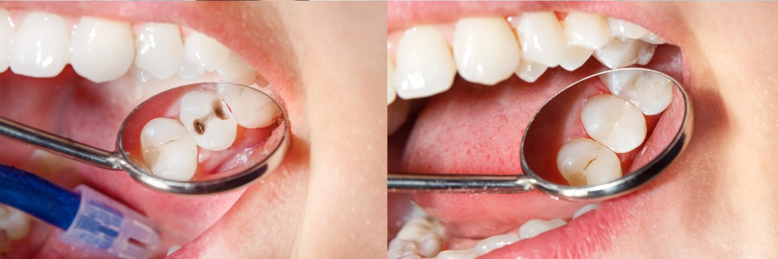 Are your amalgam fillings past their prime?