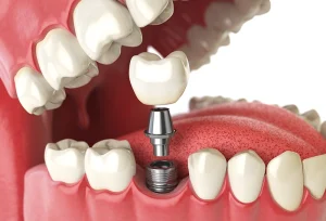 Dental Implants