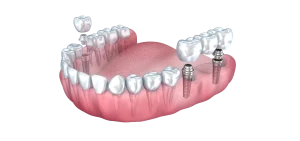 Modern solutions to replace missing teeth