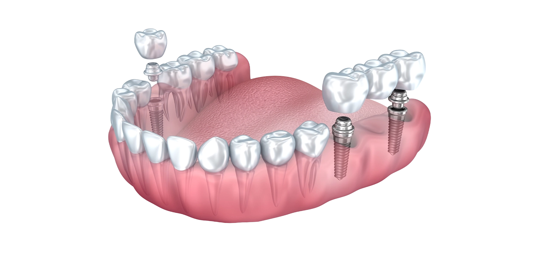 Modern solutions to replace missing teeth