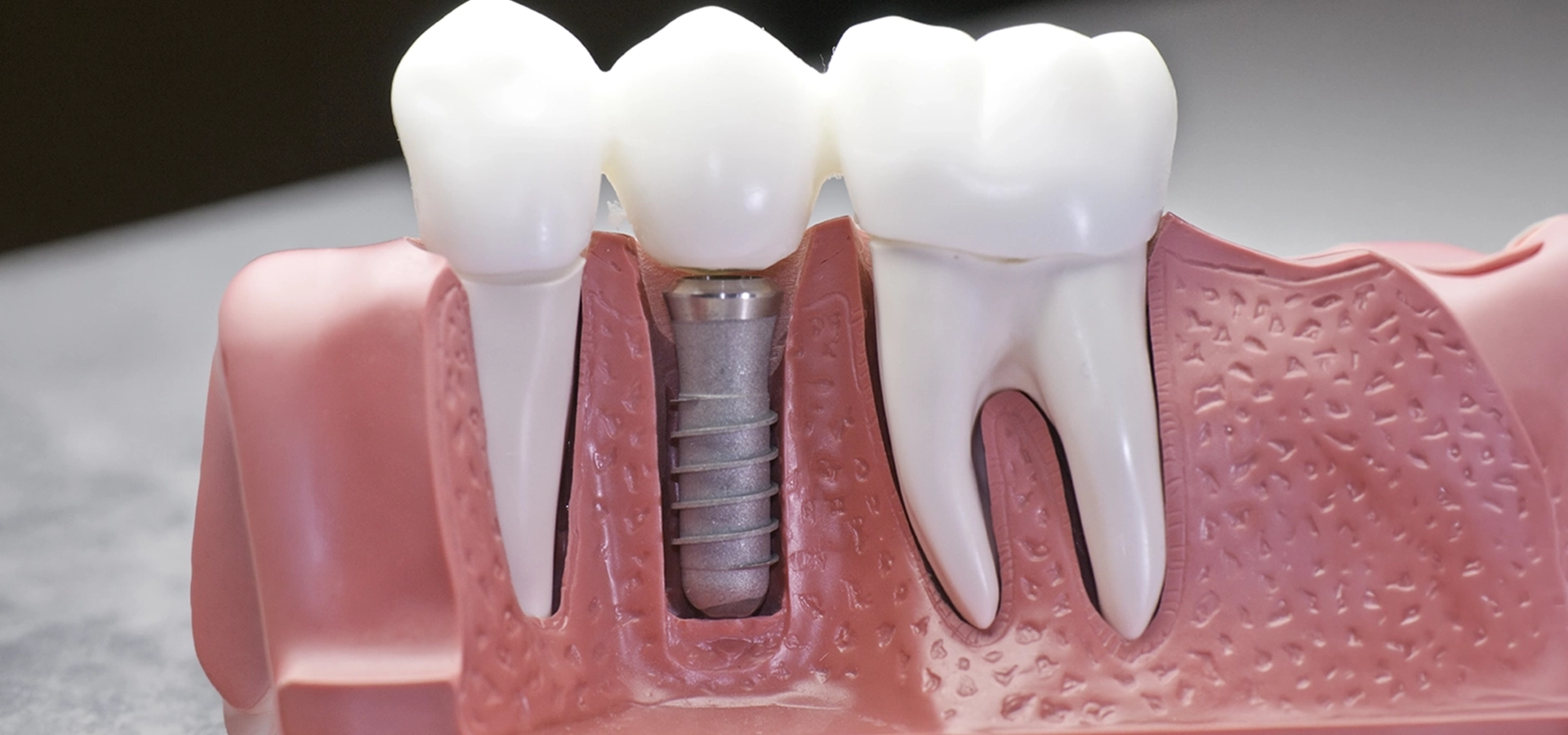 Modern solutions to replace missing teeth