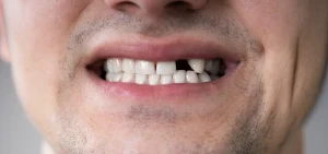 Modern solutions to replace missing teeth