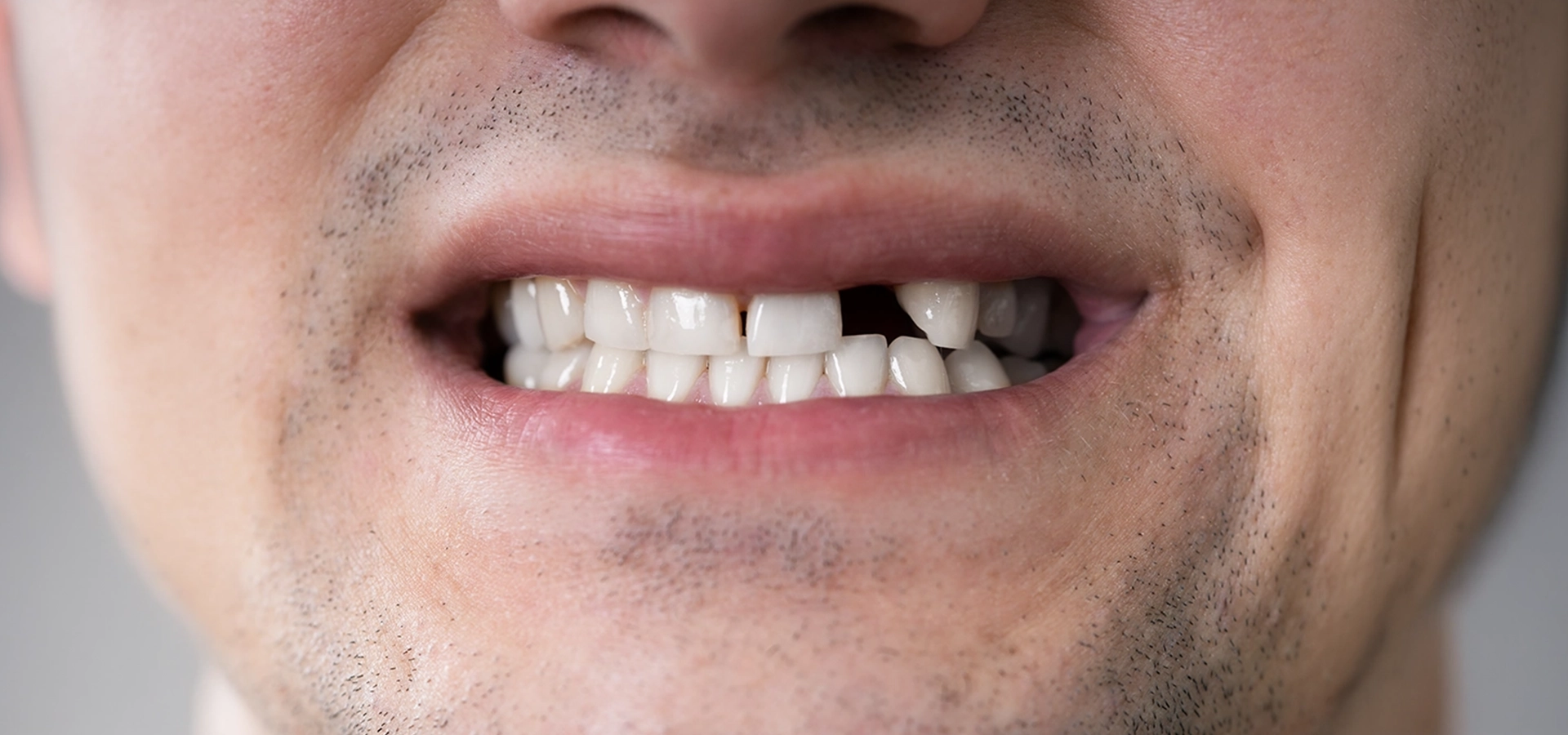 Modern solutions to replace missing teeth