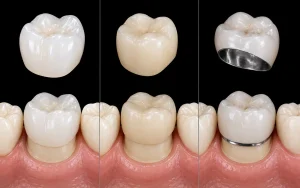modern porcelain crowns