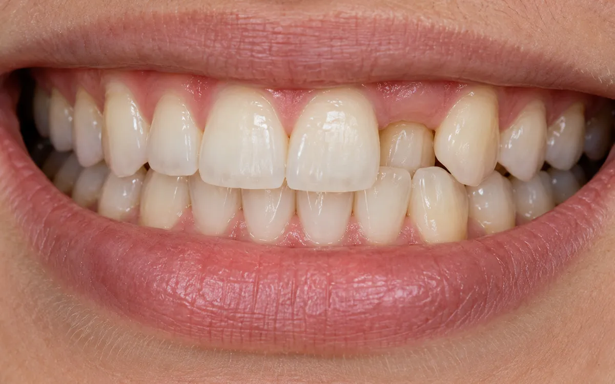 Crossbite