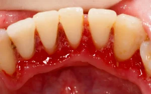 Tooth decay