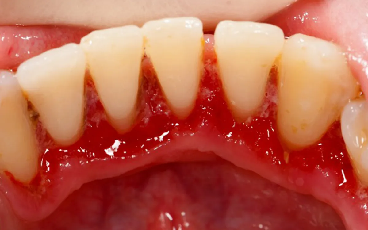 Tooth decay