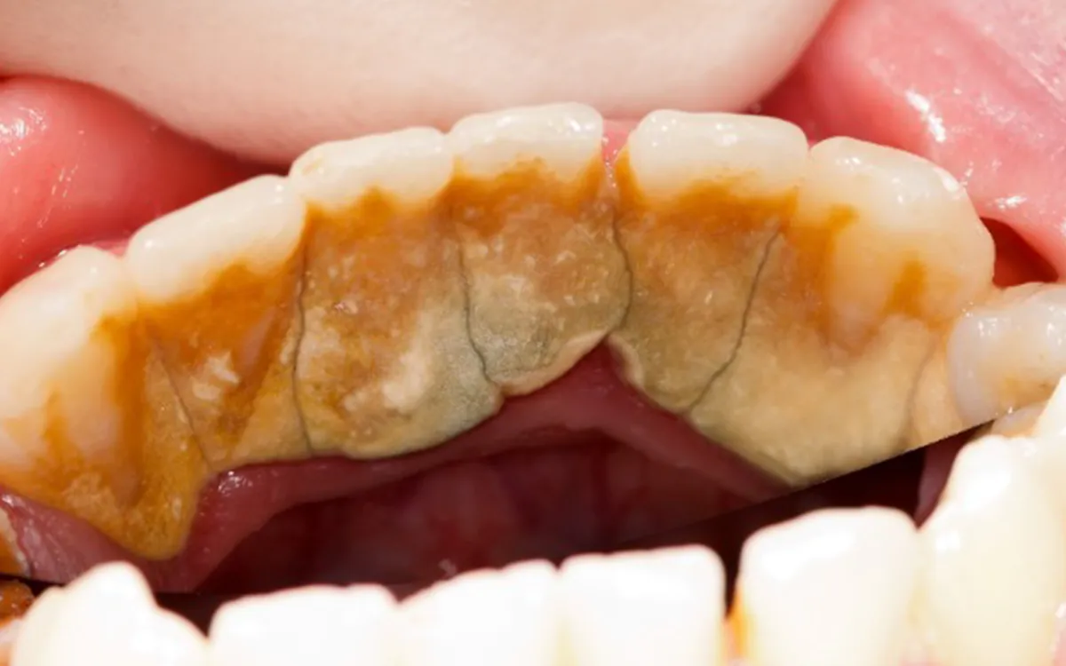 Tooth decay